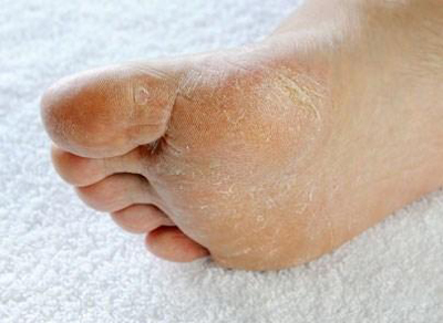 pieds mycoses ongles hygiène manucure pédicure